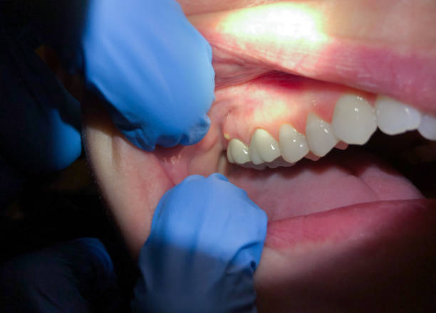 Best Emergency Tooth Extraction in Elkton, KY